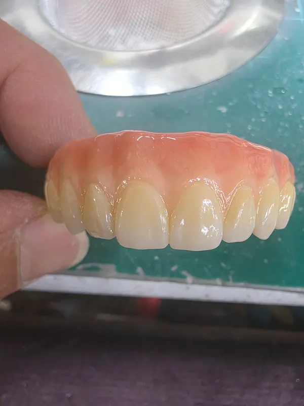 All-on-X 상부보철 (PMMA · 지르코니아) 사진 3