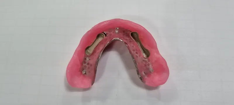 밀더바 상하악 케이스 사진 7