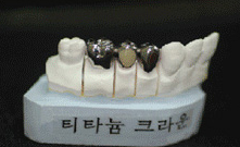 티타늄 크라운 · 티타늄 보철물 — 통상적인 티타늄 bridge