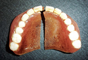 Fiber Mesh — ① 파절된 Full denture