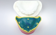 인코덴쳐 — 최종가압인상용 Resin base 및 Wax rim