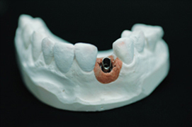 Custom abutment · 지르코니아 어버트먼트 (사진 1/4)
