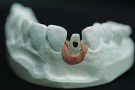 Custom abutment · 지르코니아 어버트먼트 (사진 3/4)