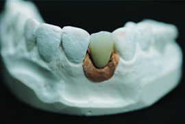 Custom abutment · 지르코니아 어버트먼트 (사진 4/4)