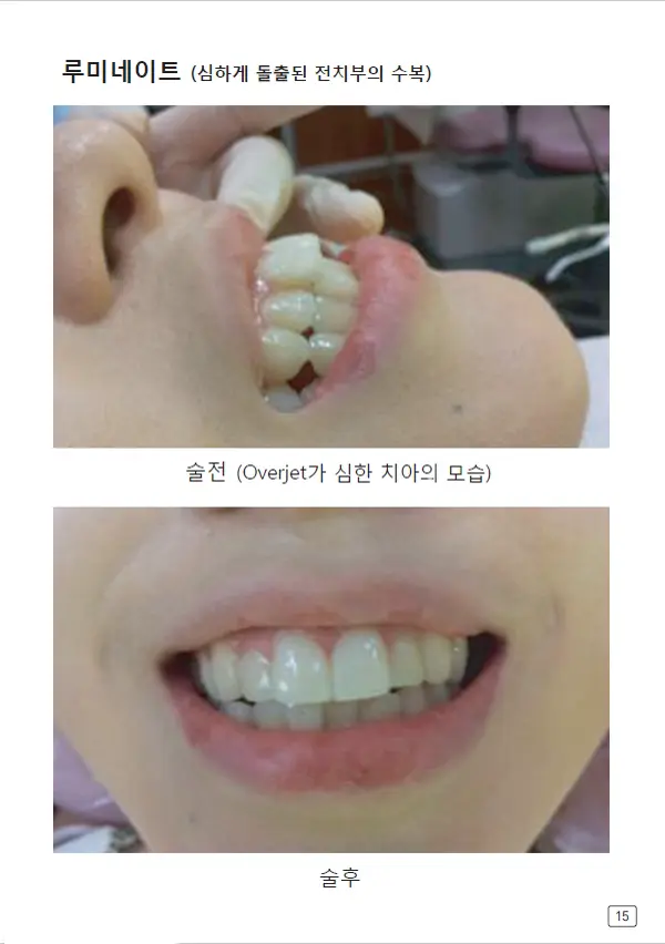 루미네이트 임상사례집 수록 이미지 15